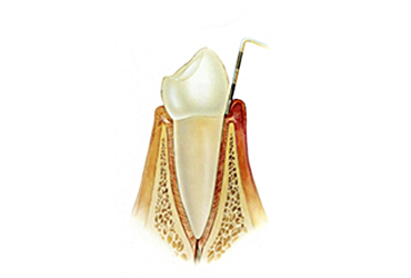 parodontologie hyperdent